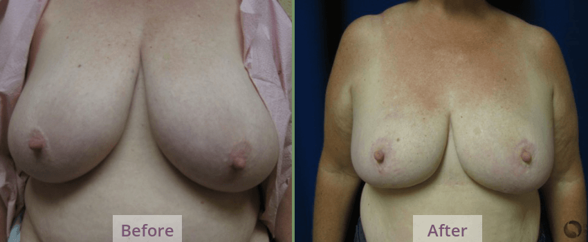 Breast Reduction Tuscon