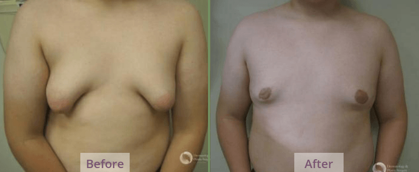 Male-Breast-Reduction-DermPlasticAZ Sierra Vista