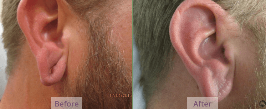 earlobe repair Tuscon