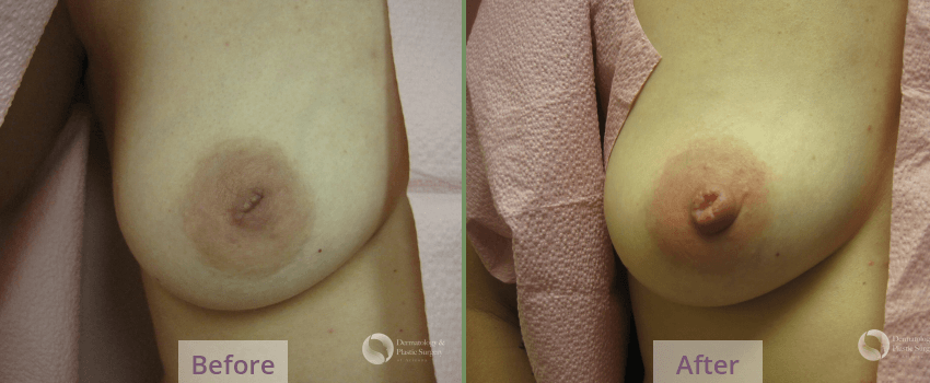 inverted nipple surgery Tuscon