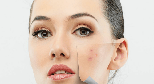 Reduce Acne Scars Sierra Vista
