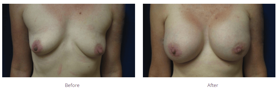 Tucson Breast Augmentation with Implants