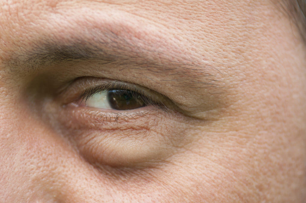 Eyesore, inflammation or bag swelling under eye Tucson
