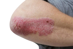 psoriasis can transfer to another person