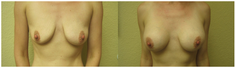 Breast Augmentation Tuscon