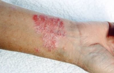 Eczema Tucson