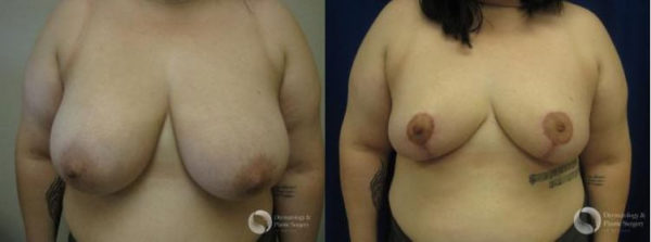 Breast Reduction Tucson