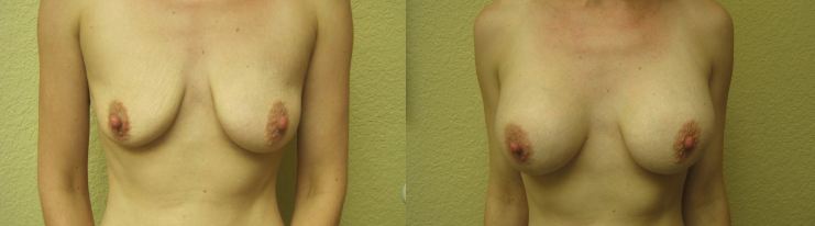 Breast Augmentation Tucson
