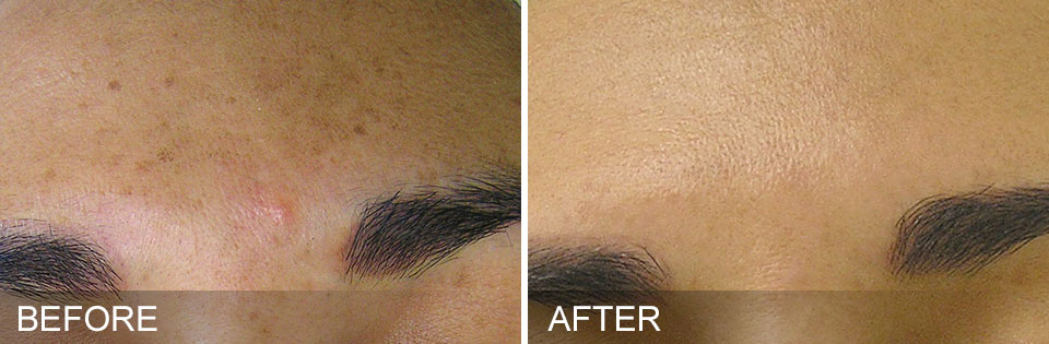 HydraFacial Before After Brown Spots