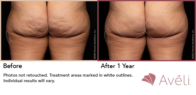 Cellulite Results, Before and After